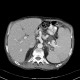 Extramedullary hematopoesis, paravertebral, splenomegally, spherocytosis, hereditary spherocytosis, intramuscular hematoma, iliacus muscle: CT - Computed tomography